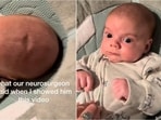 Neurosurgeon reveals baby's skull issue linked to healing process. Neurosurgeon reveals baby's skull issue linked to healing process.