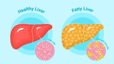 Backed by science and clinical experience, these drinks can help reduce liver fat, improve digestion, and support overall liver health. (Freepik) Backed by science and clinical experience, these drinks can help reduce liver fat, improve digestion, and support overall liver health. (Freepik)