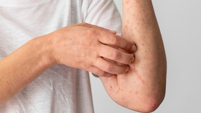 Jessica Farrington was diagnosed with non-Hodgkin follicular lymphoma in March 2025. She shared her journey on social media and said that she experienced itchy skin, among other early symptoms.(Representative picture: Freepik) Jessica Farrington was diagnosed with non-Hodgkin follicular lymphoma in March 2025. She shared her journey on social media and said that she experienced itchy skin, among other early symptoms.(Representative picture: Freepik)