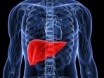 Dr Philips said night shifts mess with our natural sleep rhythms, leading to poor-quality sleep, and even if you sleep, you might not feel refreshed, which can contribute to fatty liver disease.