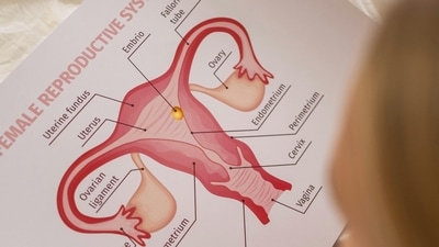 Uterine fibroids are hardly ever cancerous, according to Dr Neema Sharma. (Pexel) Uterine fibroids are hardly ever cancerous, according to Dr Neema Sharma. (Pexel)