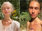 Fruit-only diets can lead to severe malnutrition and long-term health issues, doctors say. Fruit-only diets can lead to severe malnutrition and long-term health issues, doctors say.