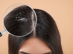 Best ways to treat dandruff Best ways to treat dandruff