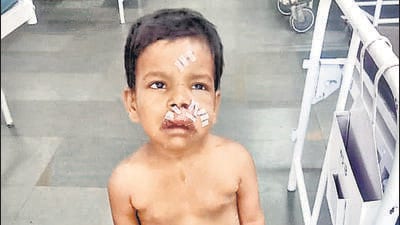 Navi Mumbai, India - Oct. 14, 2025:Three year old mauled by stray dog in Taloja undergoes reconstructive surgery in Navi Mumbai, India, on Tuesday, October 14, 2025. (Photo by Bachchan Kumar/ HT PHOTO) (HT PHOTO) Navi Mumbai, India - Oct. 14, 2025:Three year old mauled by stray dog in Taloja undergoes reconstructive surgery in Navi Mumbai, India, on Tuesday, October 14, 2025. (Photo by Bachchan Kumar/ HT PHOTO) (HT PHOTO)