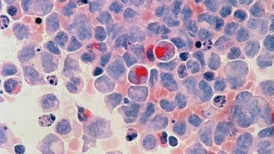 Watch out for these warning signs of Leukaemia, as highlighted by Dr Sood. (Unsplash) Watch out for these warning signs of Leukaemia, as highlighted by Dr Sood. (Unsplash)