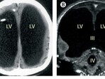 Brain scans from a 2007 study published in The Lancet revealed a French man's extraordinary condition, where his brain was severely compressed due to hydrocephalus, with only a thin layer of brain tissue remaining. (Pic courtesy: The Lancet) Brain scans from a 2007 study published in The Lancet revealed a French man's extraordinary condition, where his brain was severely compressed due to hydrocephalus, with only a thin layer of brain tissue remaining. (Pic courtesy: The Lancet)