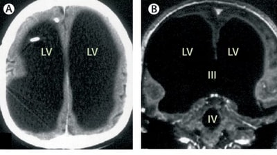 Brain scans from a 2007 study published in The Lancet revealed a French man's extraordinary condition, where his brain was severely compressed due to hydrocephalus, with only a thin layer of brain tissue remaining. (Pic courtesy: The Lancet) Brain scans from a 2007 study published in The Lancet revealed a French man's extraordinary condition, where his brain was severely compressed due to hydrocephalus, with only a thin layer of brain tissue remaining. (Pic courtesy: The Lancet)