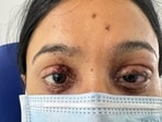 Engineering student injured in firecracker mishap at Sinhagad Road Engineering student injured in firecracker mishap at Sinhagad Road