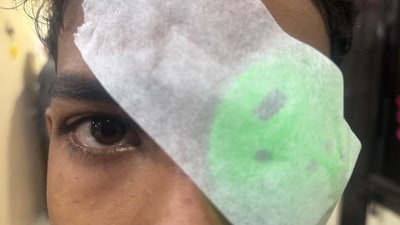 Bengaluru hospitals reported several cases, with some patients facing partial vision loss after getting injured by firecrackers during Diwali celebrations. (HT photo/For representation) Bengaluru hospitals reported several cases, with some patients facing partial vision loss after getting injured by firecrackers during Diwali celebrations. (HT photo/For representation)