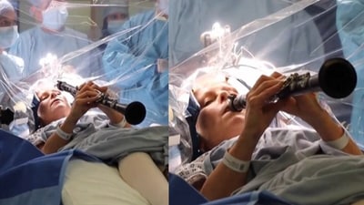 The retired speech and language therapist underwent deep-brain stimulation (DBS) at King’s College Hospital. (AP) The retired speech and language therapist underwent deep-brain stimulation (DBS) at King’s College Hospital. (AP)