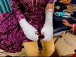 A 20-year-old woman sustained burn injuries on her hands after a acid attack by her stalker and his associates near Laxmi Bai College A 20-year-old woman sustained burn injuries on her hands after a acid attack by her stalker and his associates near Laxmi Bai College