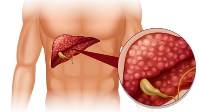 Liver cancer (primarily hepatocellular carcinoma) often develops over years, typically when the liver is under chronic stress. (Freepik) Liver cancer (primarily hepatocellular carcinoma) often develops over years, typically when the liver is under chronic stress. (Freepik)