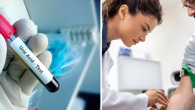 Conditions that raise the uric acid level in the blood (Freepik) Conditions that raise the uric acid level in the blood (Freepik)