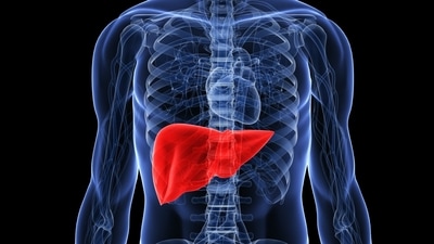 Physical signs indicating fatty liver disease and insulin resistance can include excessive visceral fat, skin tags, red or purple lines on the legs, a puffy face, and high blood pressure. (Twitter/AHealthyBod) Physical signs indicating fatty liver disease and insulin resistance can include excessive visceral fat, skin tags, red or purple lines on the legs, a puffy face, and high blood pressure. (Twitter/AHealthyBod)