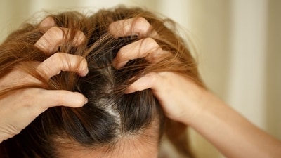 Winter hair care woes, decoded by experts (Photo: DiStefano Hair Restoration) Winter hair care woes, decoded by experts (Photo: DiStefano Hair Restoration)