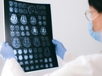 If you experience stroke symptoms, Dr Chawla cautions against ignoring them. If you experience stroke symptoms, Dr Chawla cautions against ignoring them.