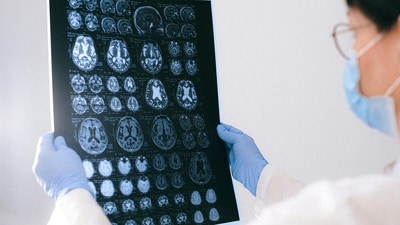 If you experience stroke symptoms, Dr Chawla cautions against ignoring them. (Pexel) If you experience stroke symptoms, Dr Chawla cautions against ignoring them. (Pexel)