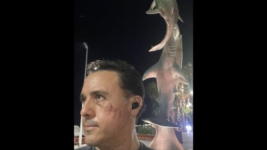 Mauricio Hoyos was bitten by a female Galapagos shark in September. (Instagram/@amaukua)