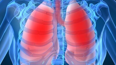Coil implantation could be an alternative to major lung-reduction surgery for patients with emphysema, a form of chronic obstructive pulmonary disease, or COPD. (Adobe Stock) Coil implantation could be an alternative to major lung-reduction surgery for patients with emphysema, a form of chronic obstructive pulmonary disease, or COPD. (Adobe Stock)