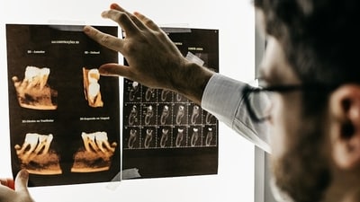 The study focused on apical periodontitis, an inflammation around the root of the tooth. (Representative image/Unsplash) The study focused on apical periodontitis, an inflammation around the root of the tooth. (Representative image/Unsplash)