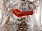 Pancreatic cancer is one of the deadliest cancers of all. A new mRNA vaccine could prevent tumors from returning. Pancreatic cancer is one of the deadliest cancers of all. A new mRNA vaccine could prevent tumors from returning.
