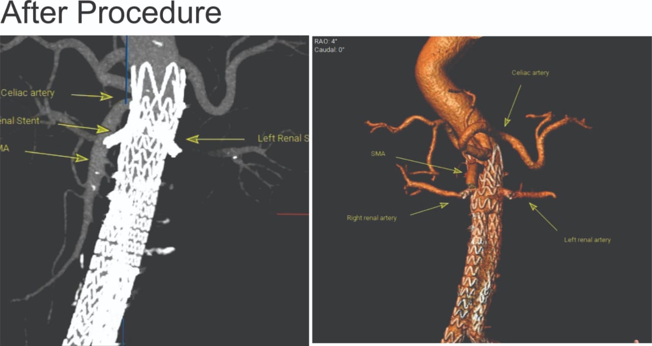 Post-procedure angiographic images showing the endovascular stent graft and covered renal stents restoring blood flow while excluding the abdominal aortic aneurysm. Post-procedure angiographic images showing the endovascular stent graft and covered renal stents restoring blood flow while excluding the abdominal aortic aneurysm.