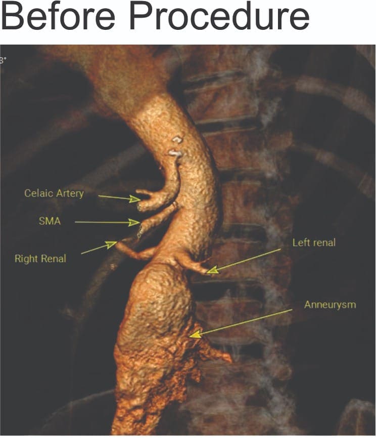 Pre-procedure CT angiographic image revealing the large abdominal aortic aneurysm involving the renal arteries before endovascular repair. Pre-procedure CT angiographic image revealing the large abdominal aortic aneurysm involving the renal arteries before endovascular repair.