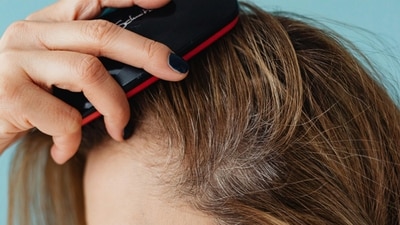 Dandruff is a chronic issue that can be inconvenient. While oils can exacerbate it, home remedies such as tea tree oil, aloe vera, and lemon juice may effectively combat the problem. (Representative Image: Pexel) Dandruff is a chronic issue that can be inconvenient. While oils can exacerbate it, home remedies such as tea tree oil, aloe vera, and lemon juice may effectively combat the problem. (Representative Image: Pexel)