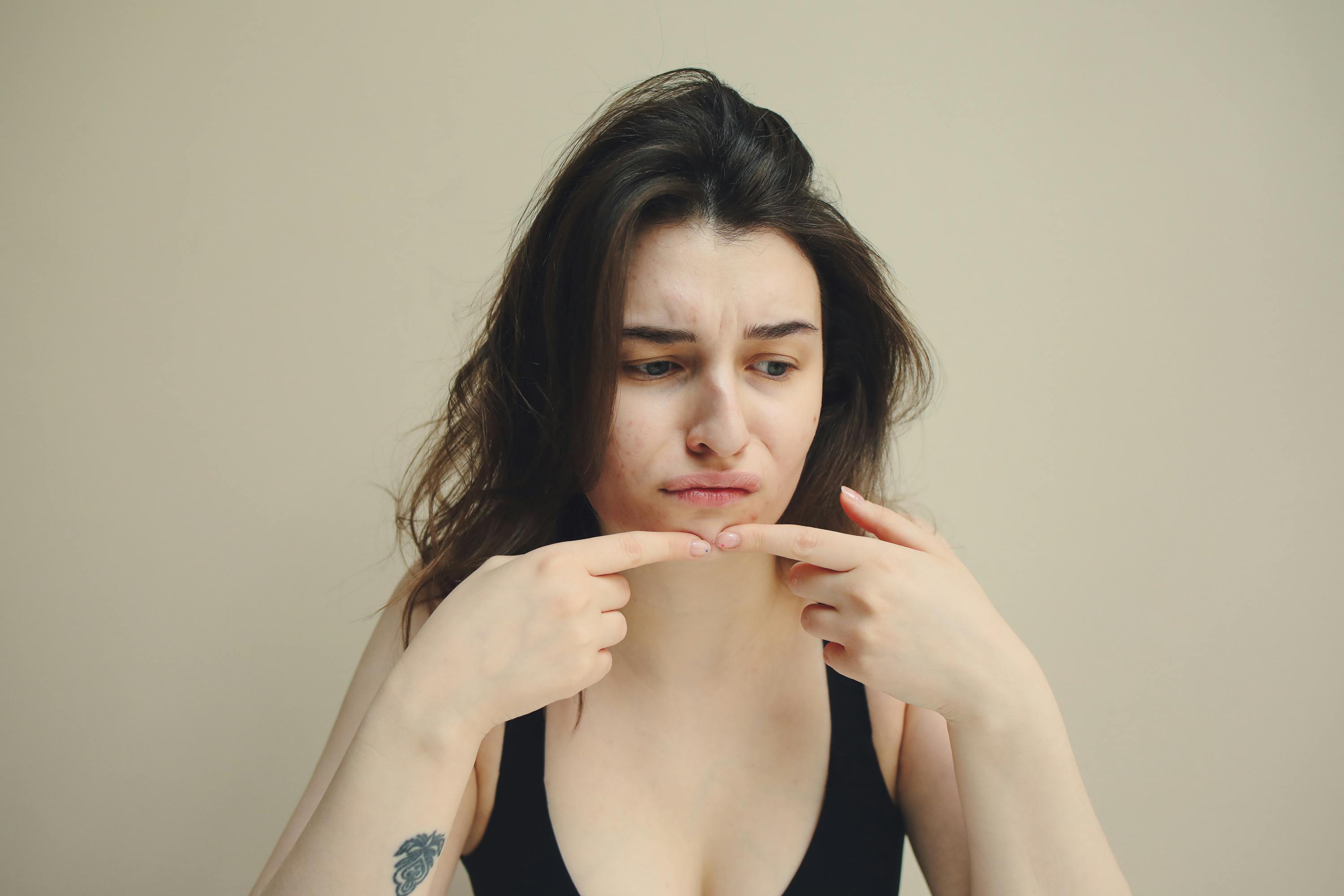 Acne is common in the 20s. (Picture credit: Pexels) Acne is common in the 20s. (Picture credit: Pexels)
