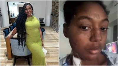 This woman's skin started peeling off after she was bit by a brown recluse spider. (Instagram) This woman's skin started peeling off after she was bit by a brown recluse spider. (Instagram)