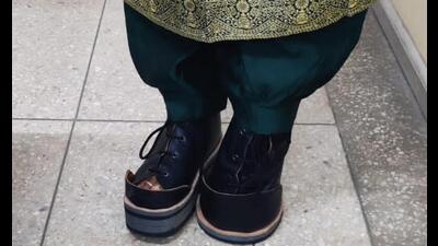 To address the problem, doctors designed a modified surgical high ankle boot with special relief at the metatarsal region. (Sourced) To address the problem, doctors designed a modified surgical high ankle boot with special relief at the metatarsal region. (Sourced)