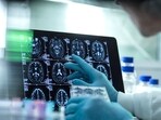 A scientist views a patient's brain MRI. A scientist views a patient's brain MRI.
