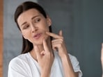 Diet choices play a key role in managing hormonal acne naturally. Diet choices play a key role in managing hormonal acne naturally.