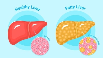 Fatty liver disease can progress to fibrosis and chronic liver failure if untreated. (Freepik) Fatty liver disease can progress to fibrosis and chronic liver failure if untreated. (Freepik)