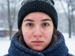 Tips to cure winter acne by an expert(AI-Generated)