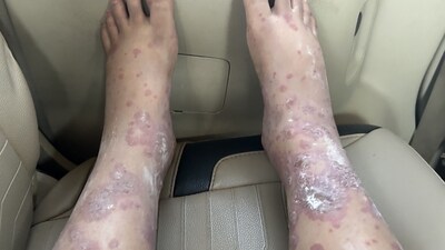 After experiencing discomfort and developing a severe infection, the woman called for accountability and better sanitation practices from the airline. (LinkedIn) After experiencing discomfort and developing a severe infection, the woman called for accountability and better sanitation practices from the airline. (LinkedIn)