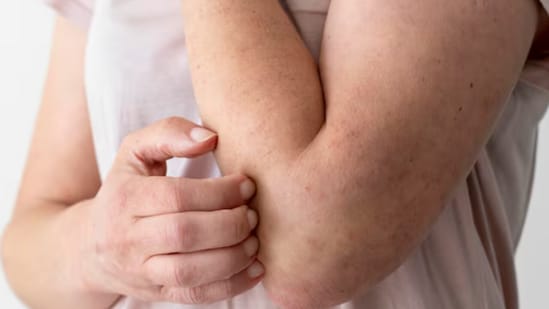 Measles cases rise in the US: Know the symptoms, prevention, and risks (Freepik)