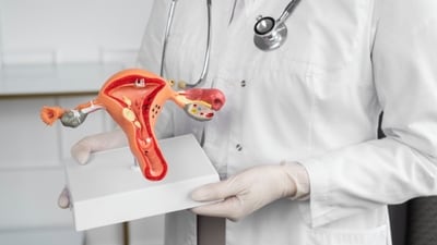 Uterine fibroids over 15 kg are rare. (Freepik) Uterine fibroids over 15 kg are rare. (Freepik)