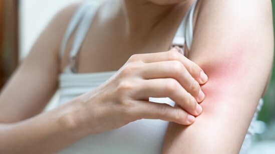 Moisturise and use hydrating facials to treat winter rash, says an expert (Shutterstock)
