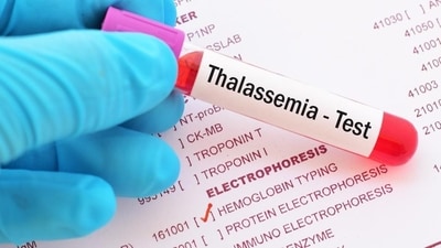 Thalassemia (Shutterstock) Thalassemia (Shutterstock)