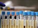 The insurance company shared the records of the pathology reports of a patient from a private multi-speciality hospital in Jejuri with the signatures of the doctor in question, Dr Sireesha Mohan. (HT)
