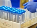 According to the MAPPM, laboratory reports bearing the name, qualifications and signature of a female pathologist - who is registered with the Telangana Medical Council - were received from multiple laboratories in Beed, Nashik, Jalgaon and Chhatrapati Sambhajinagar. (REPRESENTATIVE PHOTO)