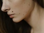 Do not cut or burn off moles on the skin!