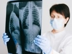 Early detection is important to ensure optimal treatment outcomes, when it comes to lung cancer.