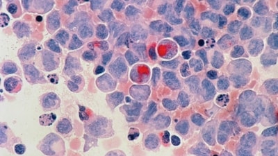 Leukaemia (Unsplash) Leukaemia (Unsplash)