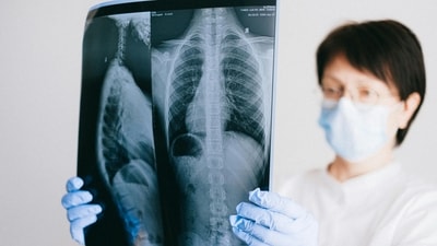 Early detection is important to ensure optimal treatment outcomes, when it comes to lung cancer. (Pexel) Early detection is important to ensure optimal treatment outcomes, when it comes to lung cancer. (Pexel)