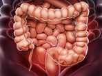 Polyps formed in the colon can turn cancerous over time. 