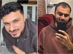 Stand-up comic Mohammed Hussain shares insights on his hair transplant experience. 