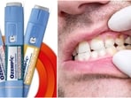 Ozempic may lead to 'Ozempic teeth,' causing dry mouth and enamel erosion, according to Dr. Curatola.