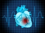 Dr Chiran Babu explains the differences between heart attacks and sudden cardiac arrest (SCA).
